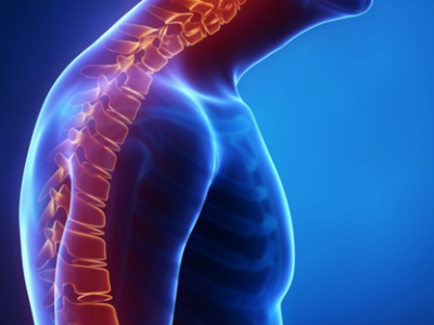 Kyphosis (Roundback) of the Spine