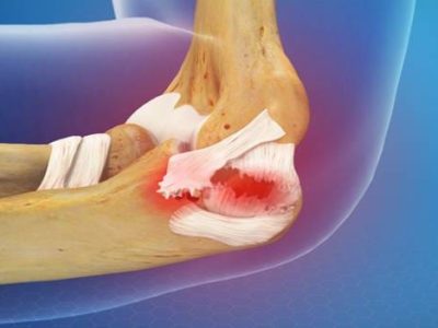 How to Recognize and Treat Arm Ligament Injuries