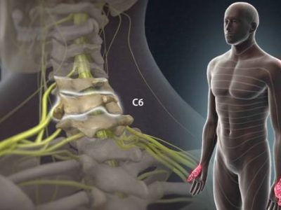 Understanding Nerve Pain in the Arms and How to Treat It