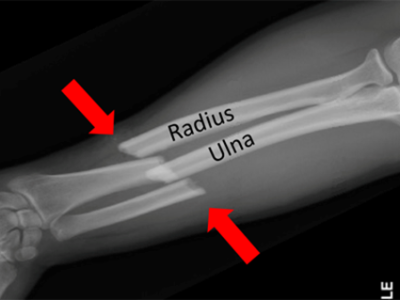 Comprehensive Guide to Adult Forearm Fractures