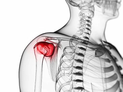 How to Recognize and Treat Bursitis in the Arm