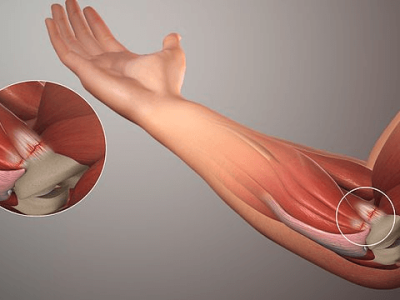 Bicep Tendonitis: Symptoms, Causes, and Effective Treatments