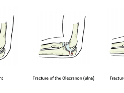 Understanding and Treating Elbow Fractures