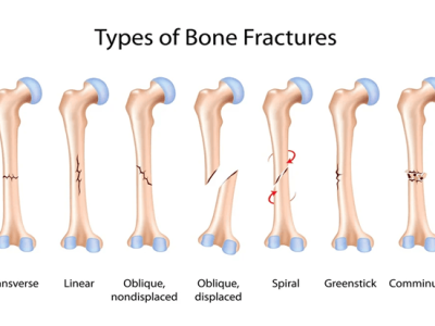 Comprehensive Guide to Understanding and Managing Different Types of Arm Fractures