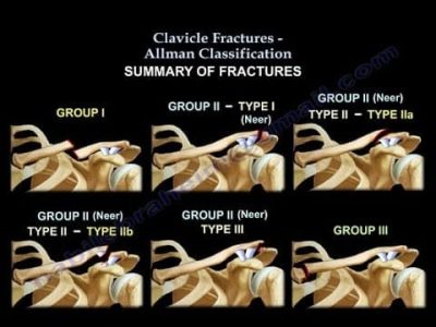 Clavicle Fractures
