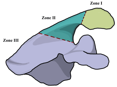 Acromial and Scapular Spine Stress Fractures
