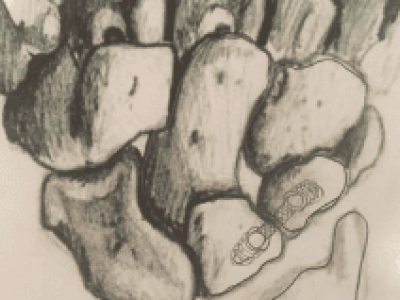 Lunotriquetral Ligament Injury