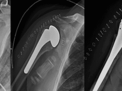 Proximal Humerus Fractures