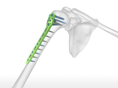 Humeral Shaft Fractures