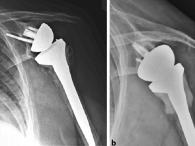 Periprosthetic Humeral Fractures
