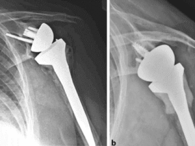 Periprosthetic Humeral Fractures