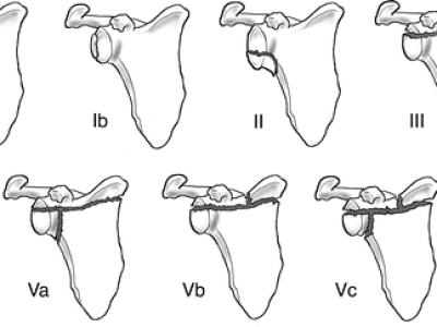 Scapula Body and Glenoid Fossa Fractures