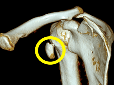 Coracoid Fractures
