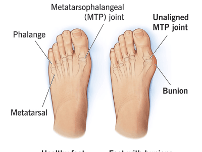 Understanding and Managing Bunions