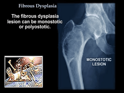 Fibrous Dysplasia