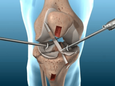 Knee Arthroscopy: An Overview