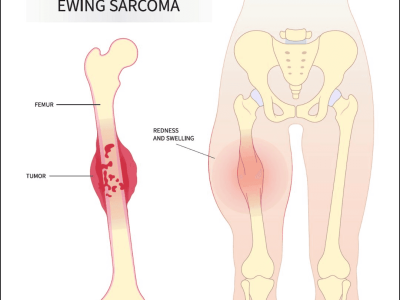 Ewing’s Sarcoma