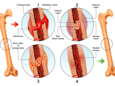 How Broken Bones Heal