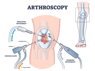 Understanding Arthroscopy: A Minimally Invasive Surgical Procedure