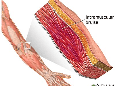 Understanding Muscle Contusions (Bruises)