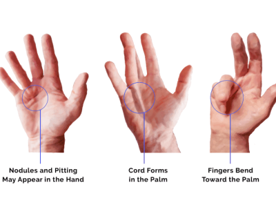 Post-Surgery Exercises for Dupuytren’s Contracture