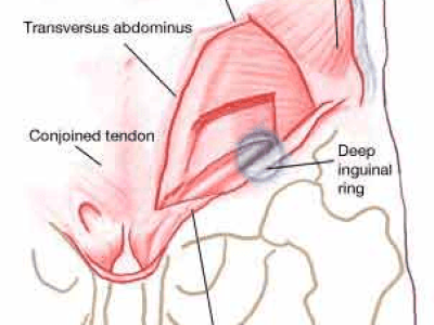 Understanding Athletic Pubalgia (Sports Hernia)