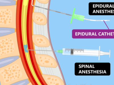 Spinal Injections