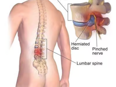 Comprehensive Treatment Options for Low Back Pain