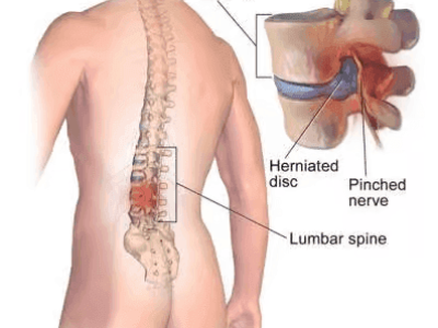Comprehensive Treatment Options for Low Back Pain