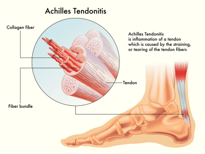 Achilles Tendinitis: Understanding, Symptoms, and Treatment