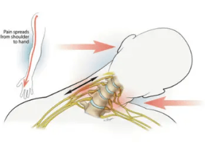 Burners and Stingers