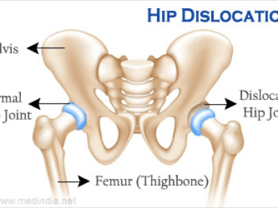 Hip Dislocation: A Serious Injury Requiring Immediate Attention