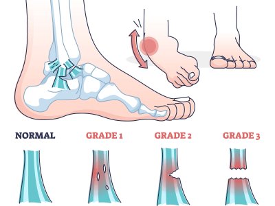 Ankle Sprains: What’s Normal and What’s Not?