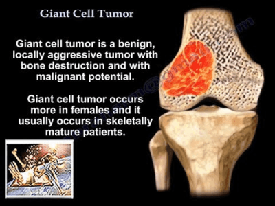 Giant Cell Tumour of Bone
