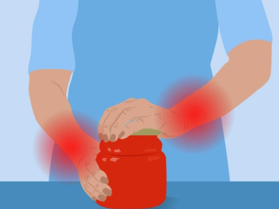 Difficulty Opening Jars? Understanding Basal Joint Arthritis