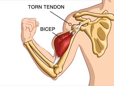 Why Does My Arm Look Like Popeye’s?