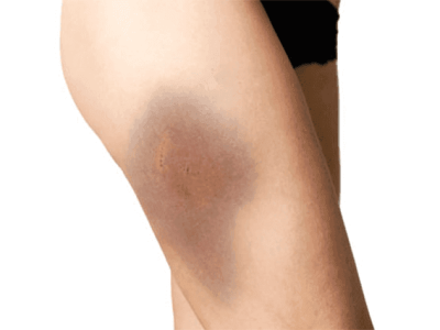 Managing Muscle Contusions: An Athlete’s Guide