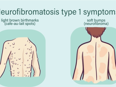 Neurofibromatosis: Understanding, Managing, and Living with the Condition