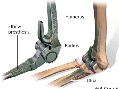 Total Elbow Replacement