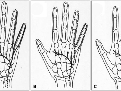 Guyon’s Canal Syndrome