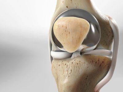 Patellofemoral Replacement: Procedure, Benefits, and Recovery