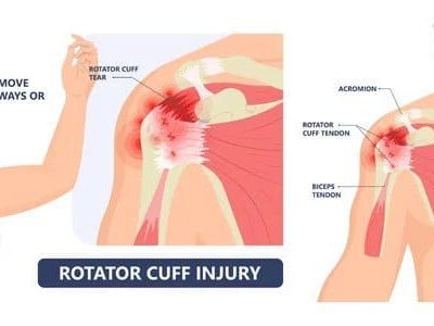 The Vital Role of the Rotator Cuff in Shoulder Health