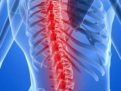 Understanding Anterior Lumbar Interbody Fusion (ALIF) in Spinal Surgery