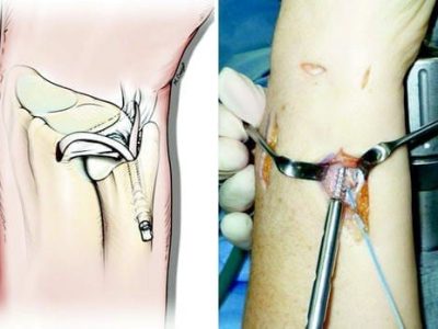Reconstruction for Interosseous Ligament Disruption