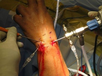 Arthroscopic and Open Triangular Fibrocartilage Complex Repair