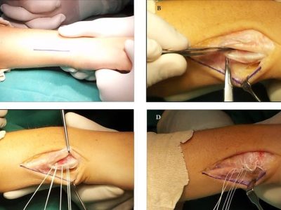 Extensor Carpi Ulnaris Subluxation