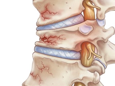 Osteoporosis and Spinal Fractures: Understanding the Link