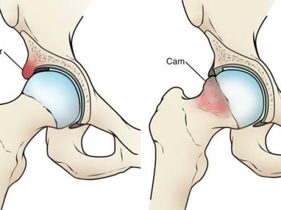 Understanding Hip Arthroscopy: A Guide to Minimally Invasive Hip Surgery