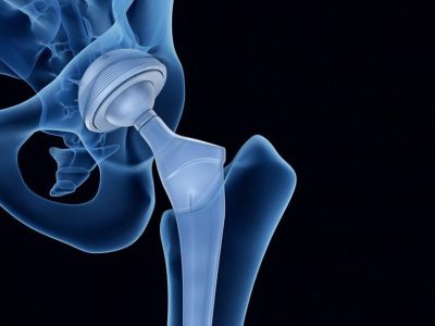 How do I protect myself from artificial joint infection?