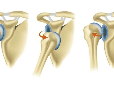 Difference Between Shoulder Dislocation and Subluxation